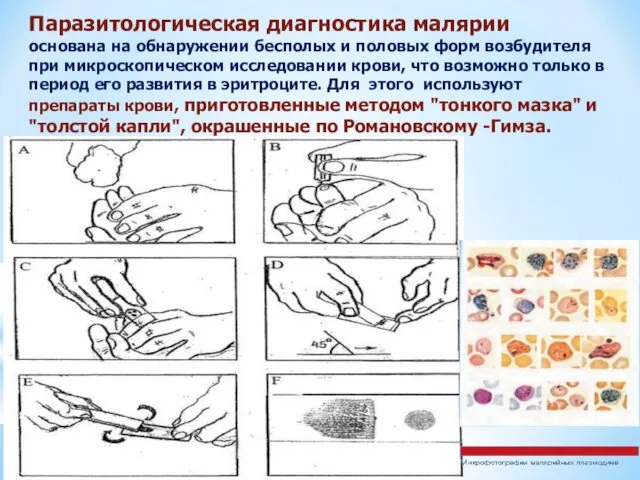 Паразитологическая диагностика малярии основана на обнаружении бесполых и половых форм возбудителя