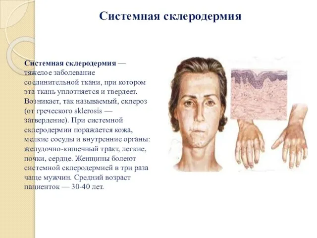 Системная склеродермия — тяжелое заболевание соединительной ткани, при котором эта ткань