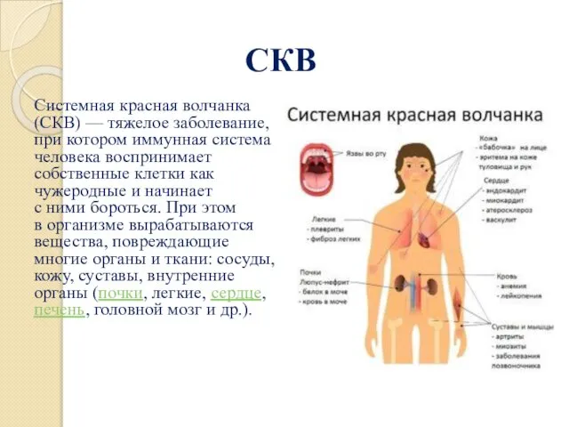 СКВ Системная красная волчанка (СКВ) — тяжелое заболевание, при котором иммунная