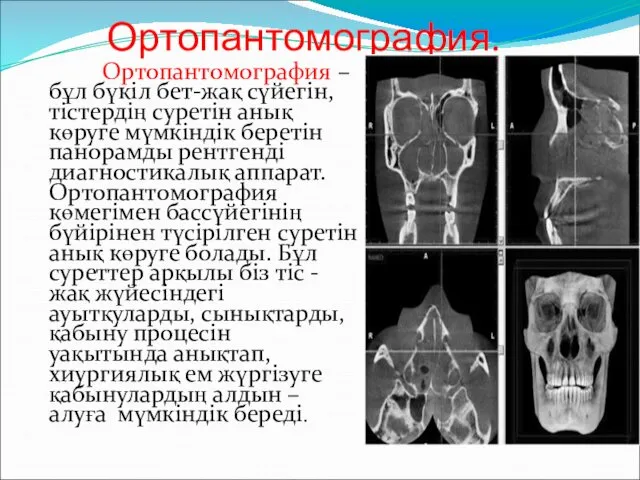 Ортопантомография. Ортопантомография – бұл бүкіл бет-жақ сүйегін, тістердің суретін анық көруге