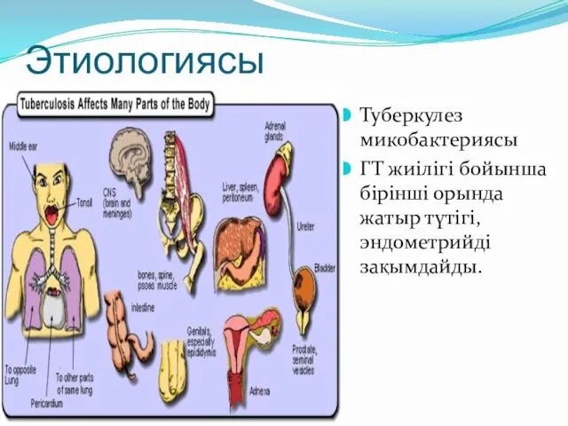 Этиологиясы Туберкулез микобактериясы ГТ жиілігі бойынша бірінші орында жатыр түтігі, эндометрийді зақымдайды.