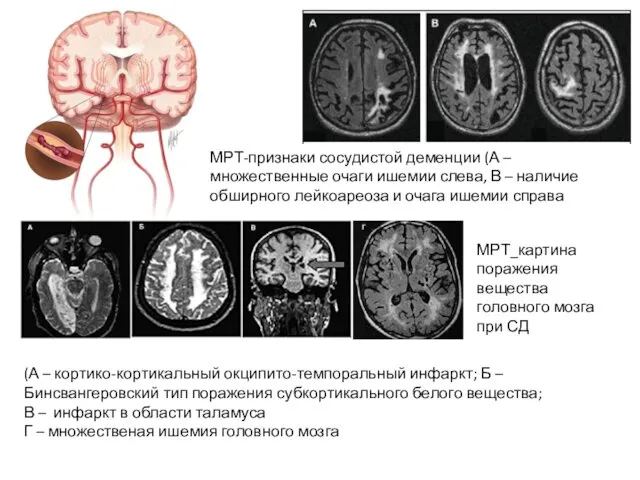 МРТ-признаки сосудистой деменции (А – множественные очаги ишемии слева, В –