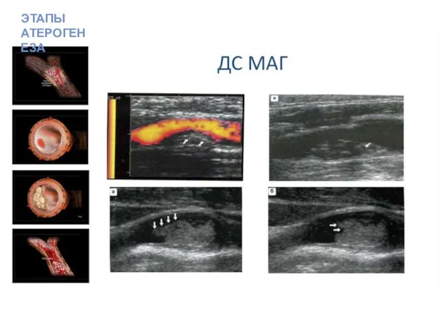 ЭТАПЫ АТЕРОГЕНЕЗА