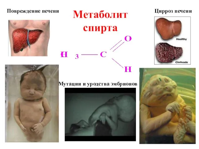 Метаболит спирта Повреждение печени Цирроз печени Мутации и уродства эмбрионов