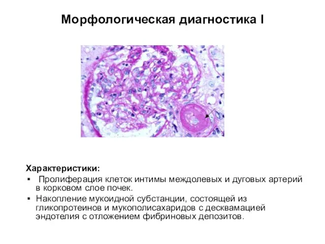 Морфологическая диагностика I Характеристики: Пролиферация клеток интимы междолевых и дуговых артерий