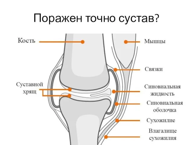 Поражен точно сустав?