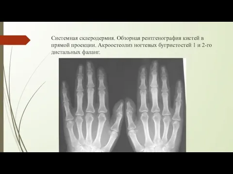 Системная склеродермия. Обзорная рентгенография кистей в прямой проекции. Акроостеолиз ногтевых бугристостей 1 и 2-го дистальных фаланг.