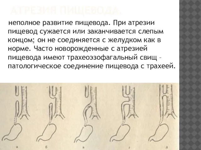 АТРЕЗИЯ ПИЩЕВОДА. неполное развитие пищевода. При атрезии пищевод сужается или заканчивается