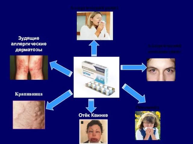 Аллергический конъюнктивит Зудящие аллергические дерматозы Крапивница Аллергический ринит Поллиноз Отёк Квинке