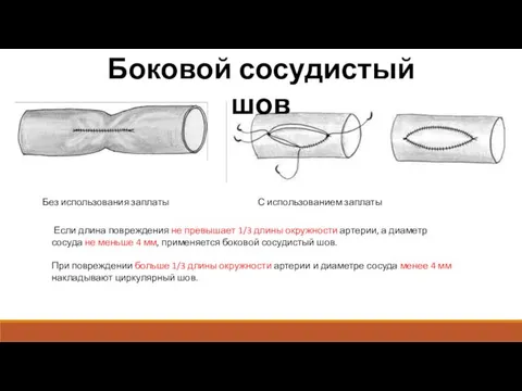 Боковой сосудистый шов Без использования заплаты С использованием заплаты Если длина