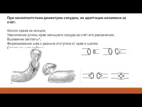 При несоответствии диаметров сосудов, их адаптация возможна за счёт: Косого среза