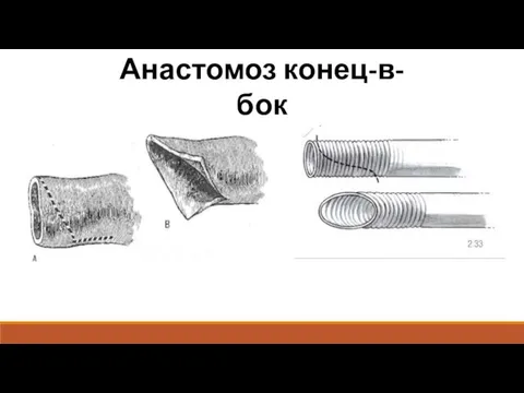 Анастомоз конец-в-бок