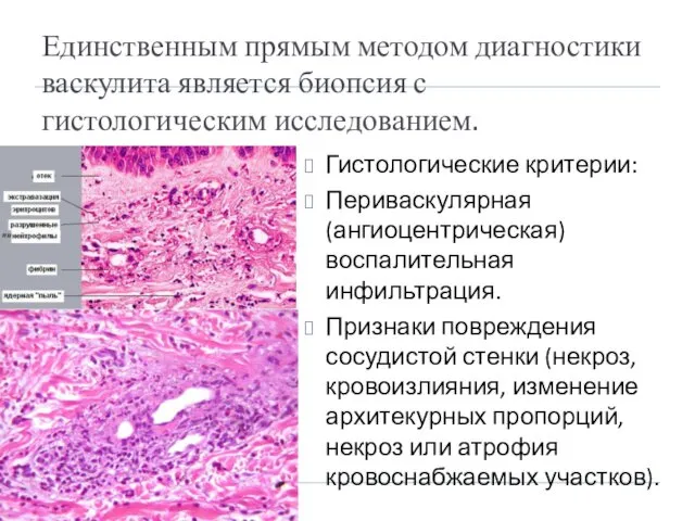 Единственным прямым методом диагностики васкулита является биопсия с гистологическим исследованием. Гистологические