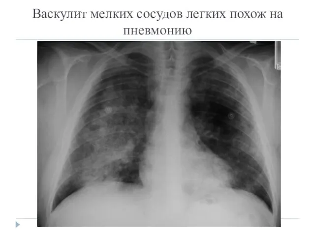 Васкулит мелких сосудов легких похож на пневмонию