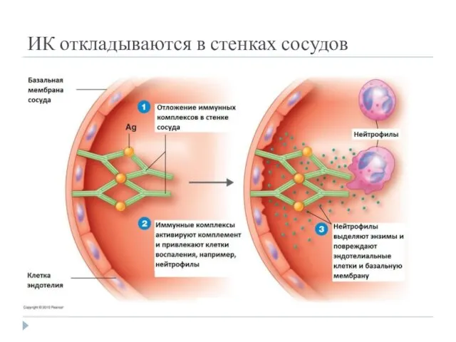 ИК откладываются в стенках сосудов