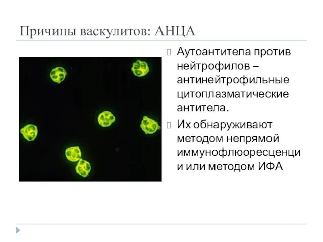 Причины васкулитов: АНЦА Аутоантитела против нейтрофилов – антинейтрофильные цитоплазматические антитела. Их