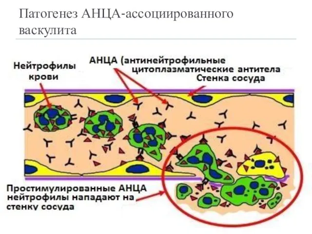 Патогенез АНЦА-ассоциированного васкулита