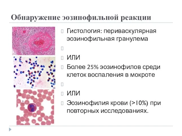 Обнаружение эозинофильной реакции Гистология: периваскулярная эозинофильная гранулема ИЛИ Более 25% эозинофилов