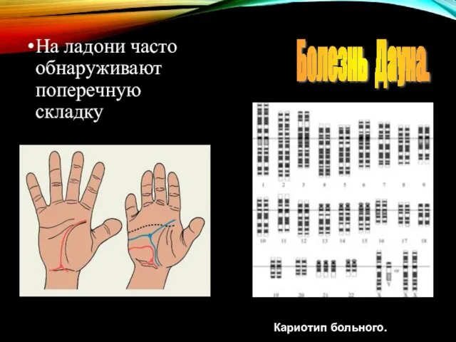 На ладони часто обнаруживают поперечную складку Болезнь Дауна. Кариотип больного.