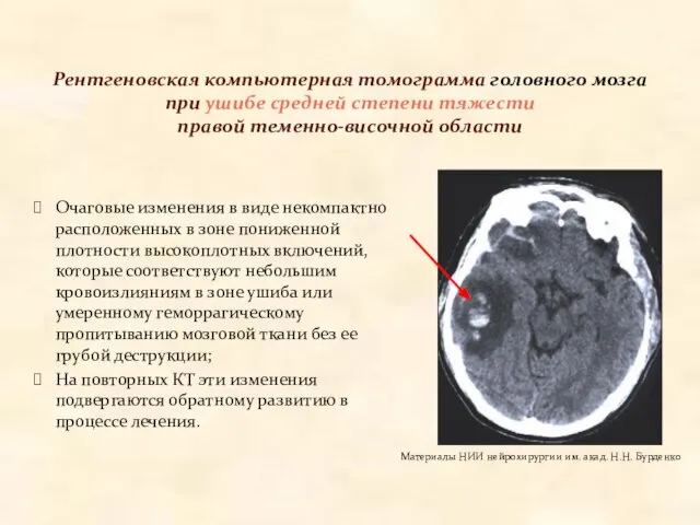 Рентгеновская компьютерная томограмма головного мозга при ушибе средней степени тяжести правой