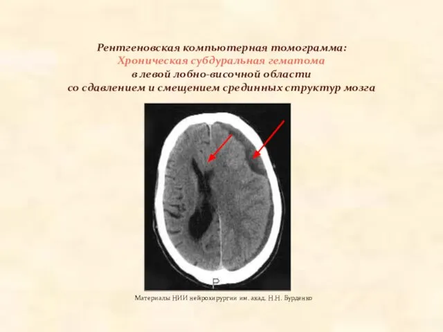 Рентгеновская компьютерная томограмма: Хроническая субдуральная гематома в левой лобно-височной области со