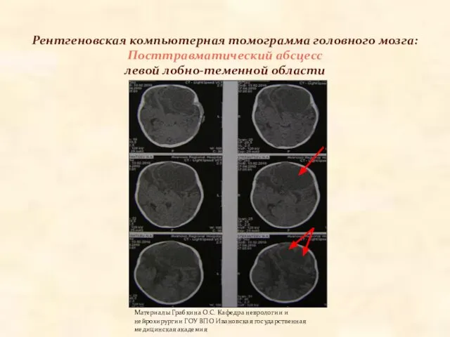 Рентгеновская компьютерная томограмма головного мозга: Посттравматический абсцесс левой лобно-теменной области Материалы