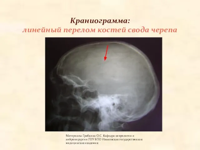 Краниограмма: линейный перелом костей свода черепа Материалы Грабкина О.С. Кафедра неврологии