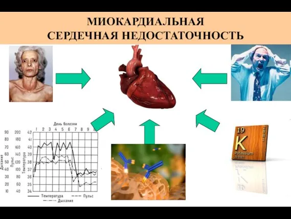 МИОКАРДИАЛЬНАЯ СЕРДЕЧНАЯ НЕДОСТАТОЧНОСТЬ