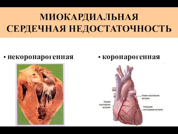 МИОКАРДИАЛЬНАЯ СЕРДЕЧНАЯ НЕДОСТАТОЧНОСТЬ коронарогенная некоронарогенная