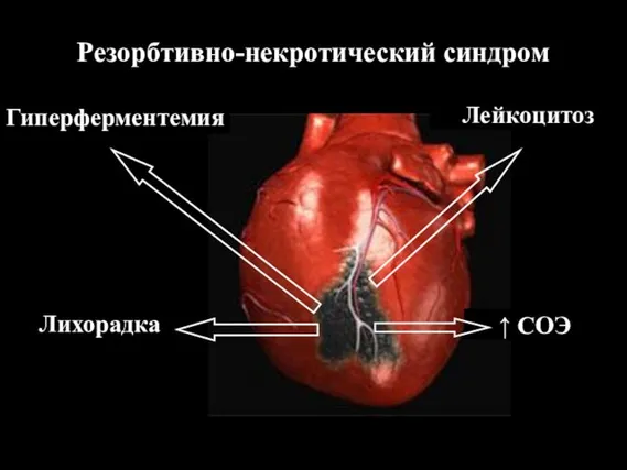 Резорбтивно-некротический синдром Гиперферментемия Лихорадка Лейкоцитоз ↑ СОЭ