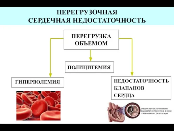 ПЕРЕГРУЗКА ОБЪЕМОМ ГИПЕРВОЛЕМИЯ ПОЛИЦИТЕМИЯ НЕДОСТАТОЧНОСТЬ КЛАПАНОВ СЕРДЦА ПЕРЕГРУЗОЧНАЯ СЕРДЕЧНАЯ НЕДОСТАТОЧНОСТЬ