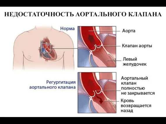 НЕДОСТАТОЧНОСТЬ АОРТАЛЬНОГО КЛАПАНА