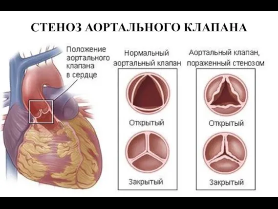 СТЕНОЗ АОРТАЛЬНОГО КЛАПАНА