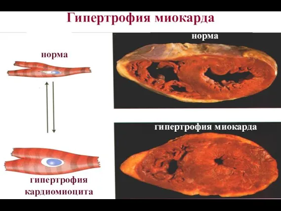 Гипертрофия миокарда гипертрофия кардиомиоцита норма гипертрофия миокарда норма