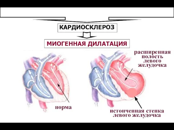 КАРДИОСКЛЕРОЗ МИОГЕННАЯ ДИЛАТАЦИЯ норма истонченная стенка левого желудочка расширенная полость левого желудочка