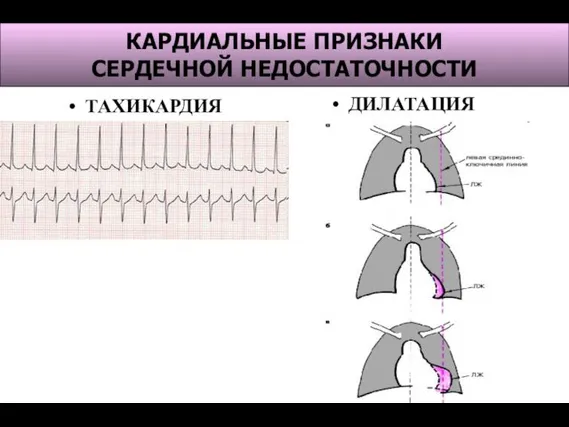 КАРДИАЛЬНЫЕ ПРИЗНАКИ СЕРДЕЧНОЙ НЕДОСТАТОЧНОСТИ ТАХИКАРДИЯ ДИЛАТАЦИЯ