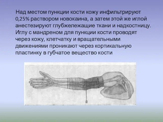 Над местом пункции кости кожу инфильтрируют 0,25% раствором новокаина, а затем