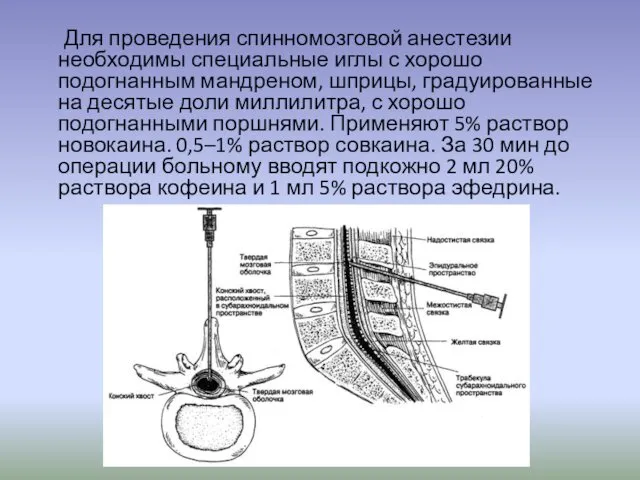 Для проведения спинномозговой анестезии необходимы специальные иглы с хорошо подогнанным мандреном,