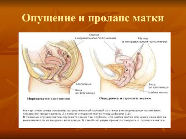 Опущение и пролапс матки