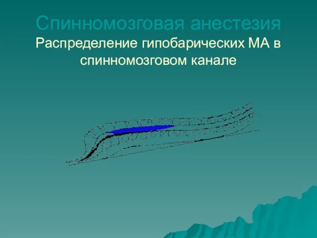 Спинномозговая анестезия Распределение гипобарических МА в спинномозговом канале