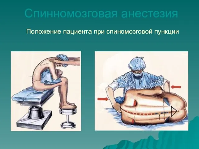 Спинномозговая анестезия Положение пациента при спиномозговой пункции