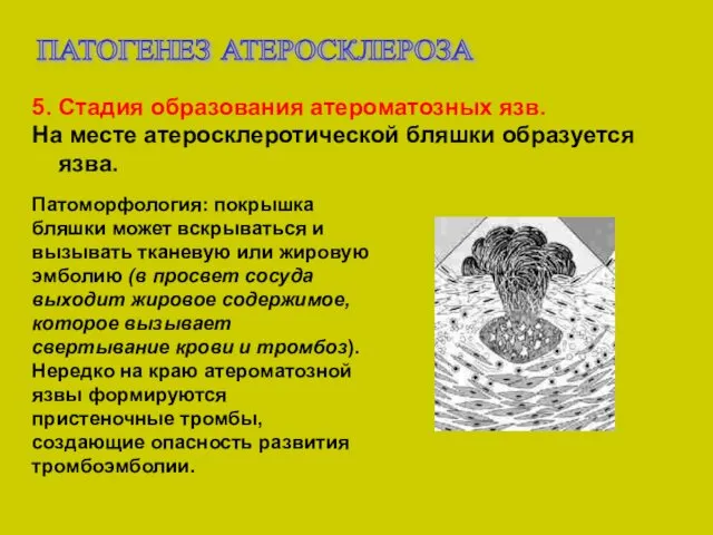 ПАТОГЕНЕЗ АТЕРОСКЛЕРОЗА 5. Стадия образования атероматозных язв. На месте атеросклеротической бляшки