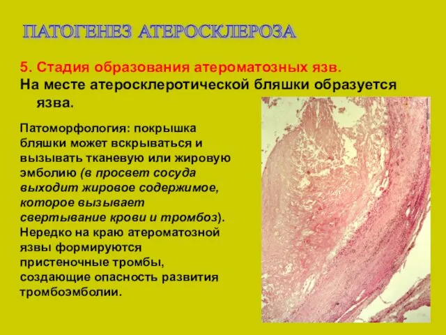 ПАТОГЕНЕЗ АТЕРОСКЛЕРОЗА 5. Стадия образования атероматозных язв. На месте атеросклеротической бляшки