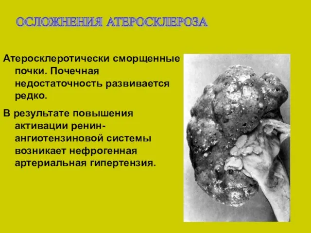 ОСЛОЖНЕНИЯ АТЕРОСКЛЕРОЗА Атеросклеротически сморщенные почки. Почечная недостаточность развивается редко. В результате