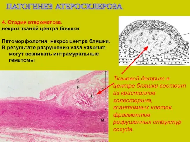 ПАТОГЕНЕЗ АТЕРОСКЛЕРОЗА 4. Стадия атероматоза. некроз тканей центра бляшки Патоморфология: некроз