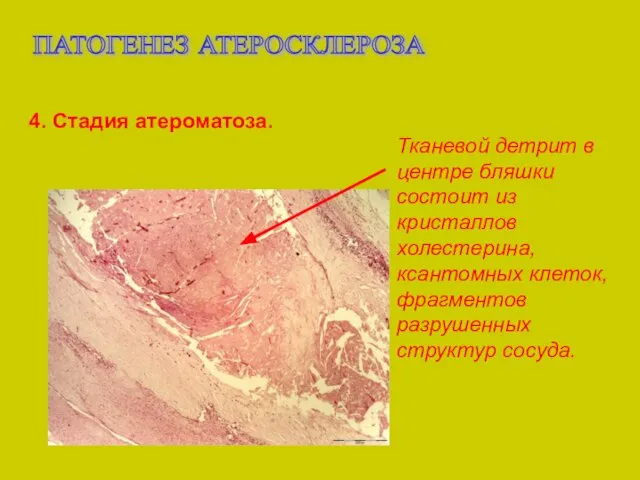 ПАТОГЕНЕЗ АТЕРОСКЛЕРОЗА 4. Стадия атероматоза. Тканевой детрит в центре бляшки состоит