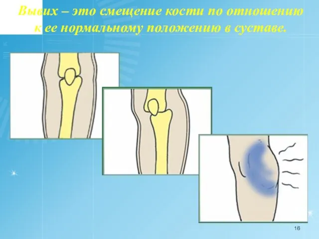 Вывих – это смещение кости по отношению к ее нормальному положению в суставе.