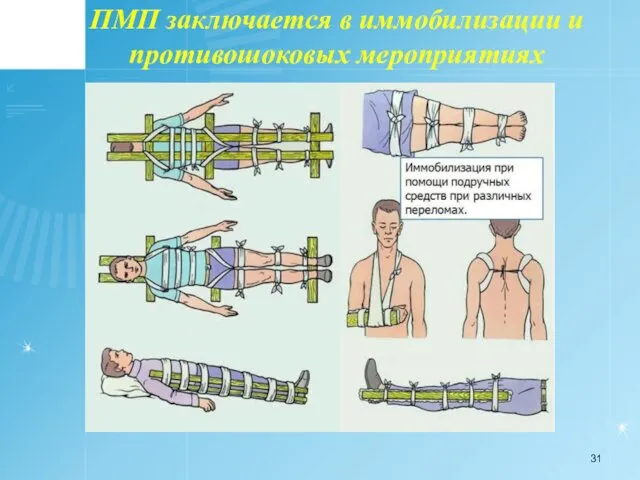 ПМП заключается в иммобилизации и противошоковых мероприятиях