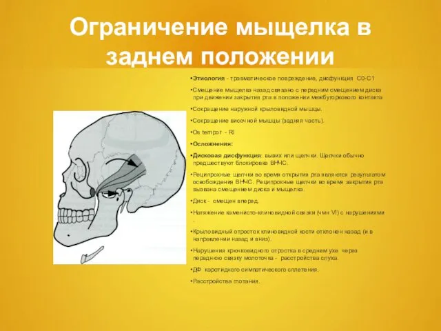 Ограничение мыщелка в заднем положении Этиология - травматическое повреждение, дисфункция С0-С1