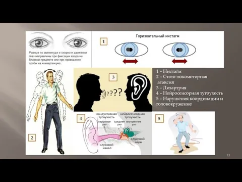 1 – Нистагм 2 – Стато-локомоторная атаксия 3 – Дизартрия 4